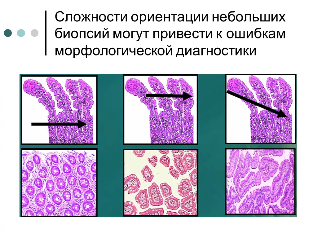 ошибки диагностики целиакии