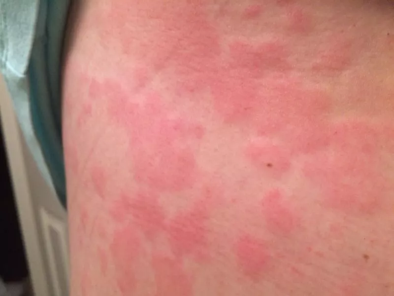 Mast cell activation syndrome.jpg