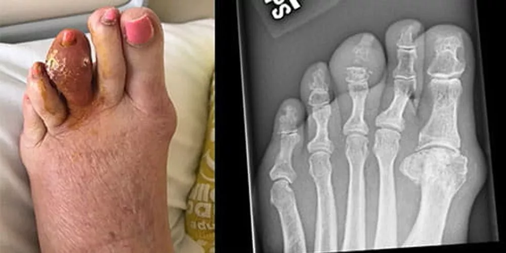 middle-toe-gout.jpg