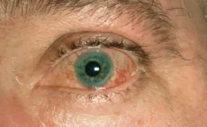 Конъюнктивит при реактивном артрите