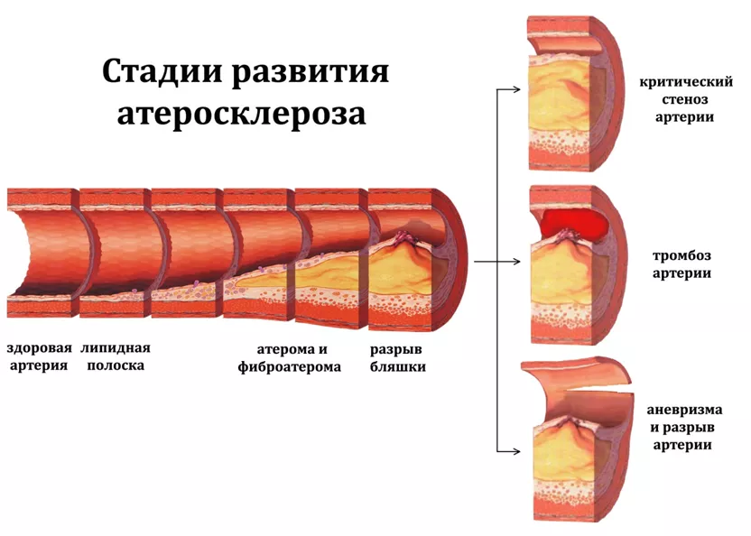 стадии развития атеросклероза
