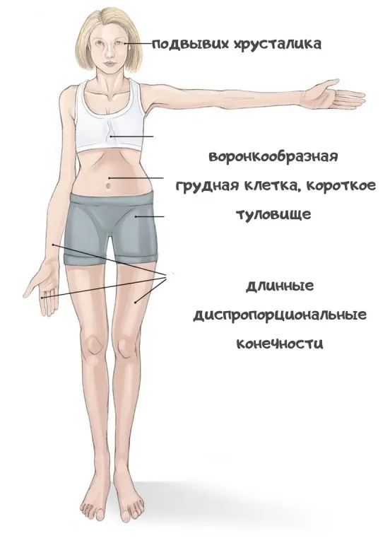 Синдром Марфана. Наиболее частые фенотипические признаки.