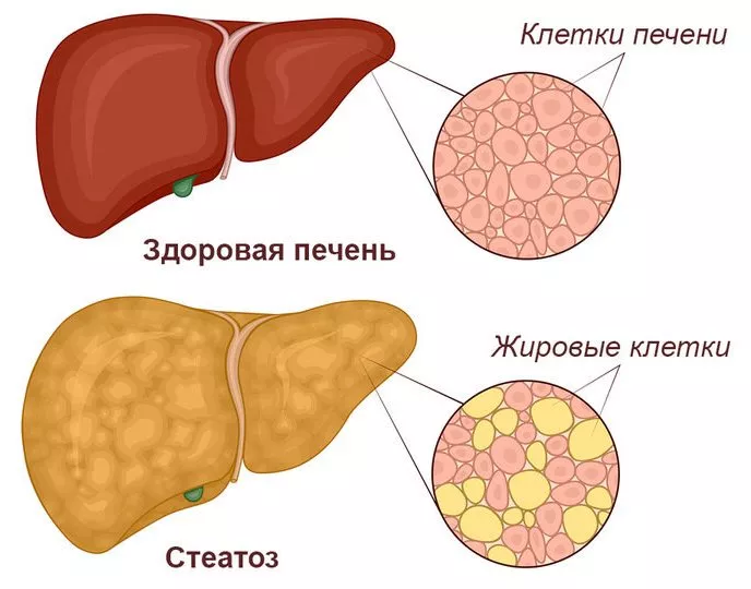Неалкогольная жировая болезнь печени.