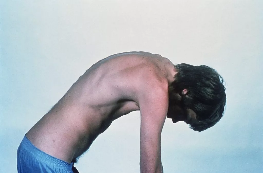 Выраженный кифоз (наружное искривление) позвоночника вследствие сращения позвонков у пациента с болезнью Бехтерева