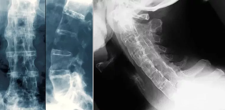 Слева и в центре: "Бамбуковый позвоночник" при анкилозирующем спондилите.