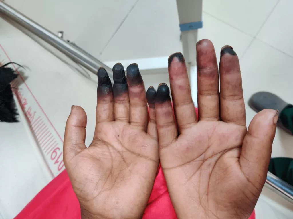 гангрена 2.png