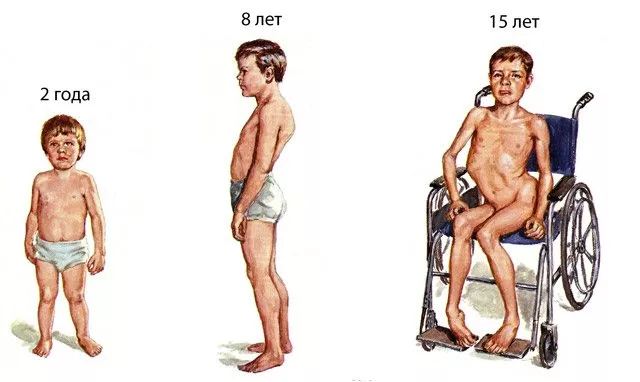 Рис 5. Мышечные и скелетные нарушения у пациента с МДД, прогрессирующие с возрастом [4]