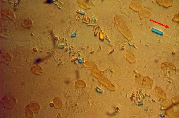calcium-pyrophospate-crystals-mandell-sized_ru.jpg