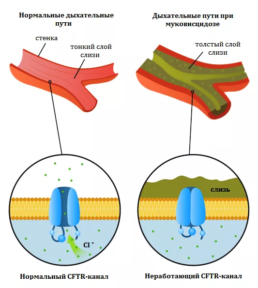  Патология CFTR-каналов
