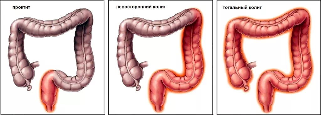 Локализация язвенного колита