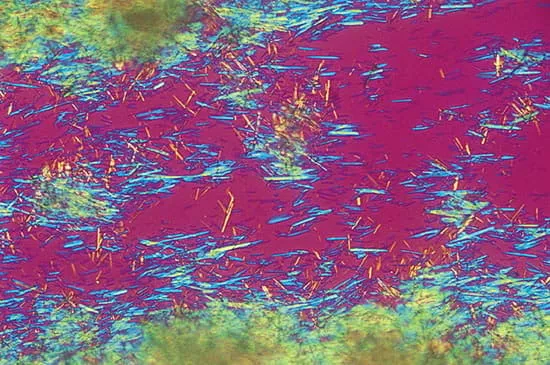 gout_crystals_high_ru.jpg