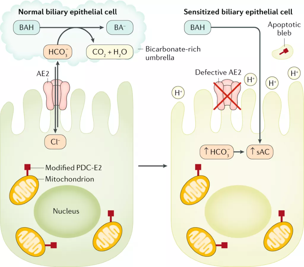 Нарушение защитного бикарбонатного зонтика над билиарными эпителиальными клетками вследствие дефекта анионного обменника AE2