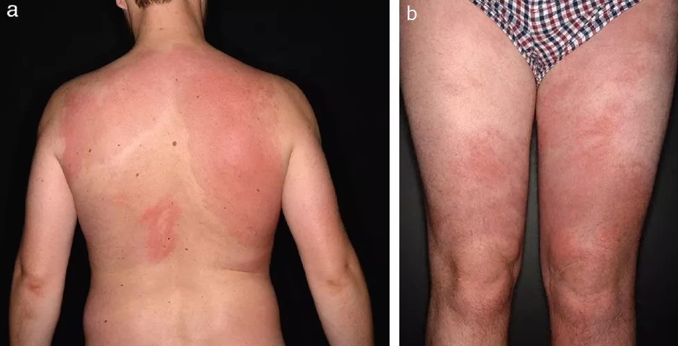 Рис 2. Эризипелоидподобная (рожеподобная) сыпь на спине (а) и на ногах (b) у пациентки с семейной средиземноморской лихорадкой [6].