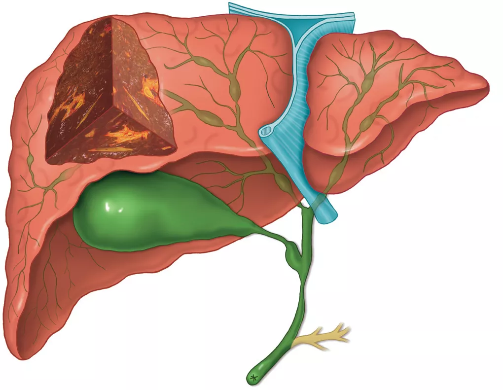 Патологические изменения желчевыводящих путей при первичном склерозирующем холангите (макроскопические изменения)