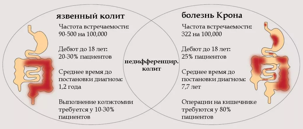 Болезнь Крона и язвенный колит