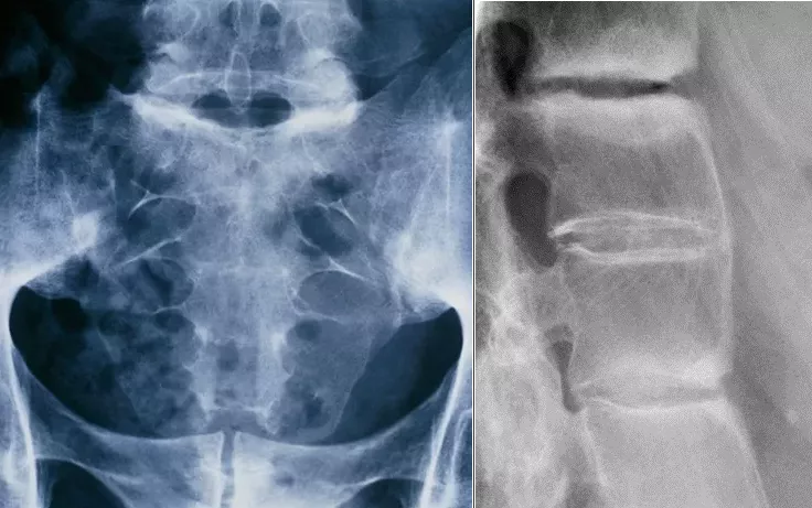 Рентгенограмма таза и крестцового отдела позвоночника (прямая проекция) пациента, страдающего АС
