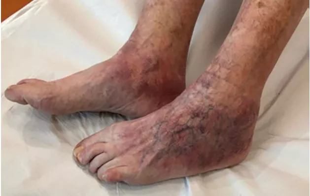 Рис 2 - хронический атрофический акродерматит [2]