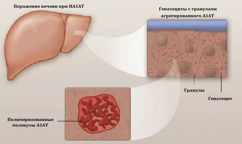 Поражение печени при дефиците А1АТ