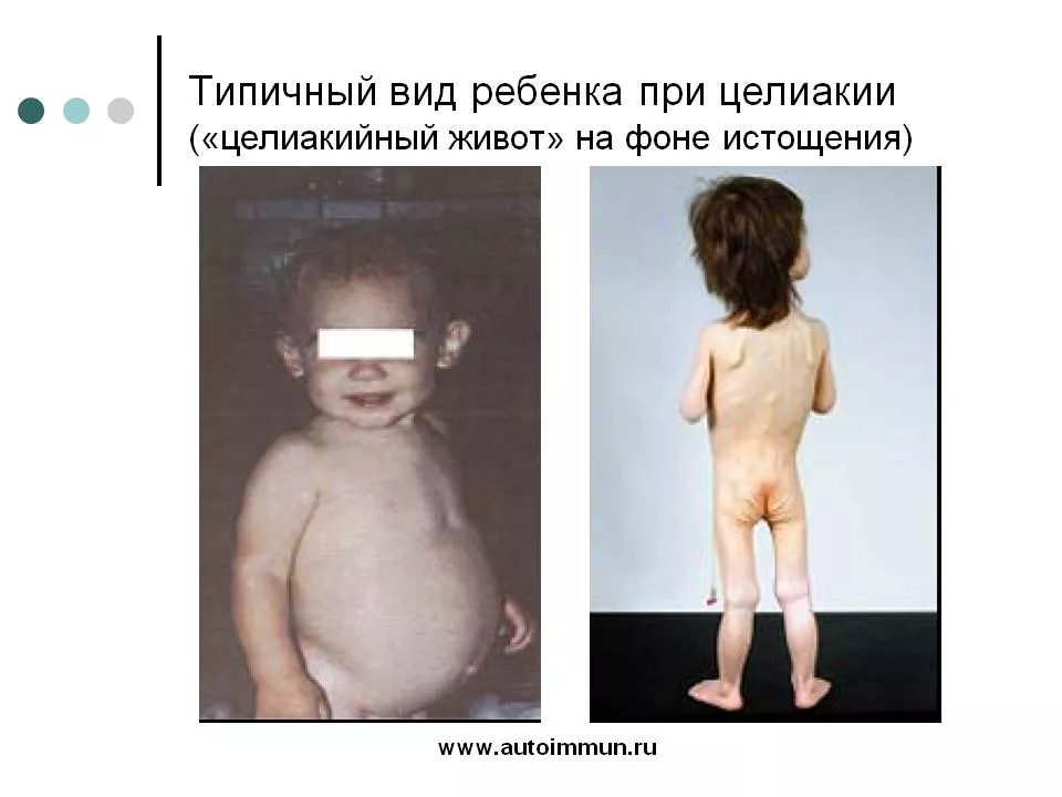 типичный вид ребенка при целиакии