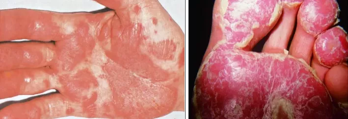 Бленоррагическая кератодермия на ладони и на стопе у пациента с реактивным артритом