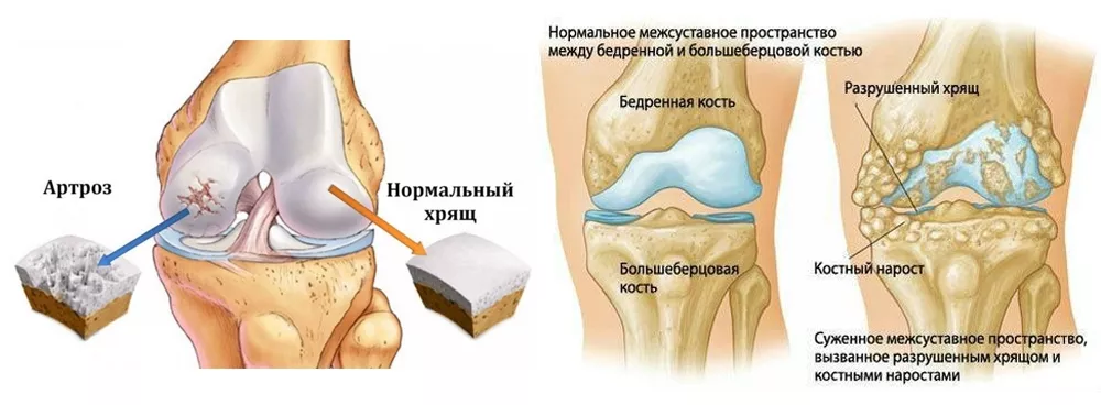 osteoartrit.jpg