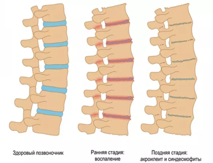 Сращение позвонков при болезни Бехтерева (формирование анкилоза)