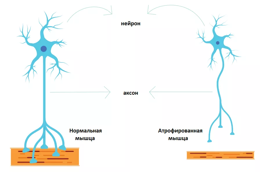 Дегенерация мотонейрона приводит к постепенной атрофии мышц