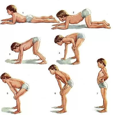 Рис 6. Симптом Говерса (“взбирание по самому себе”) у пациента с МДД [4]