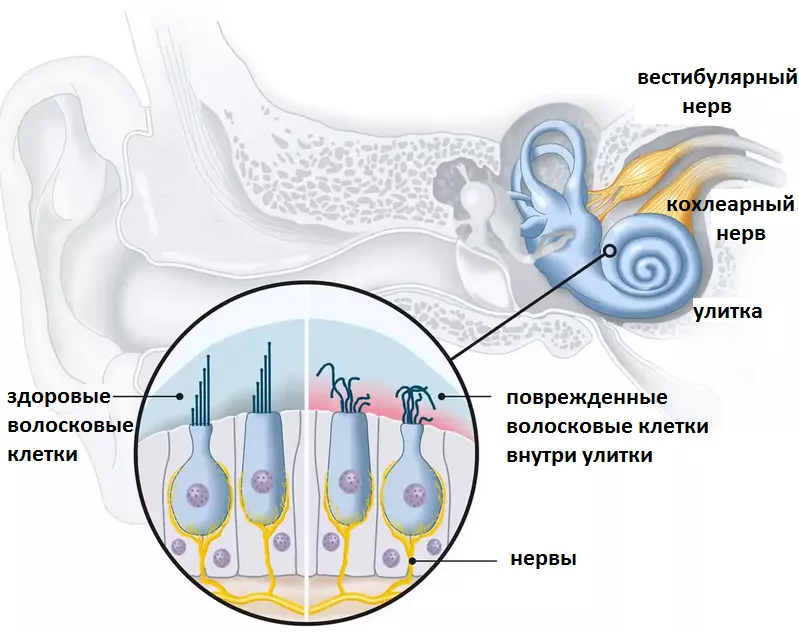 Повреждение волосковых клеток внутреннего уха при нейросенсорной тугоухости