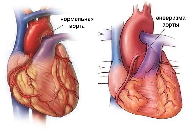 Аневризма восходящей дуги аорты