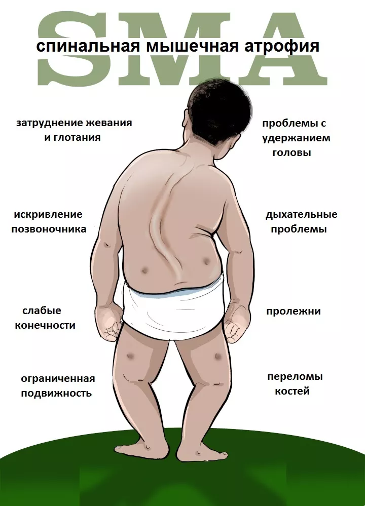 Клинические проявления спинальной мышечной атрофии