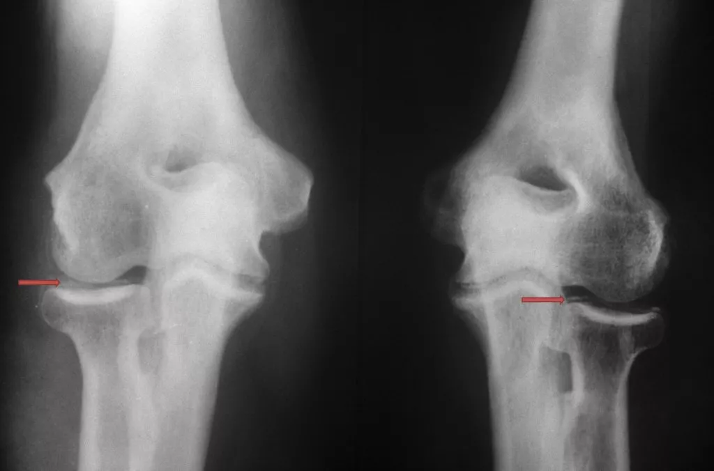 c0174603_pseudogout_calcium_pyrophosphate_dihydrate_crystal_deposition_disease_science_photo_library_high_arrows_ru.jpg