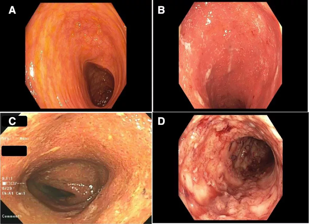 Ulcerative colitis endoscopy.png
