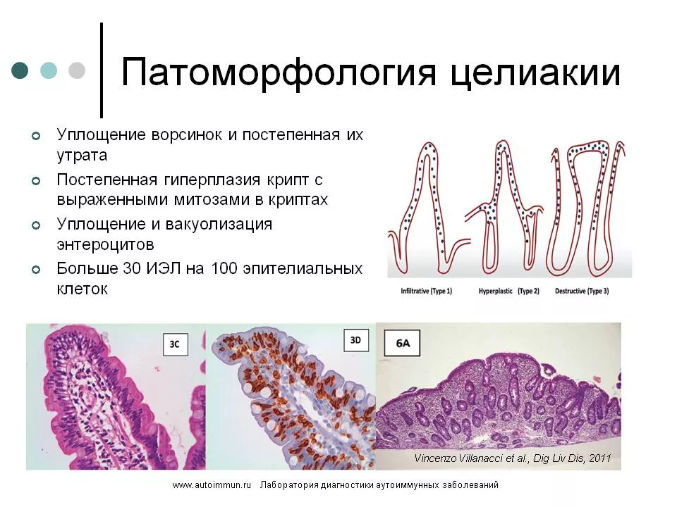 патоморфология целиакии