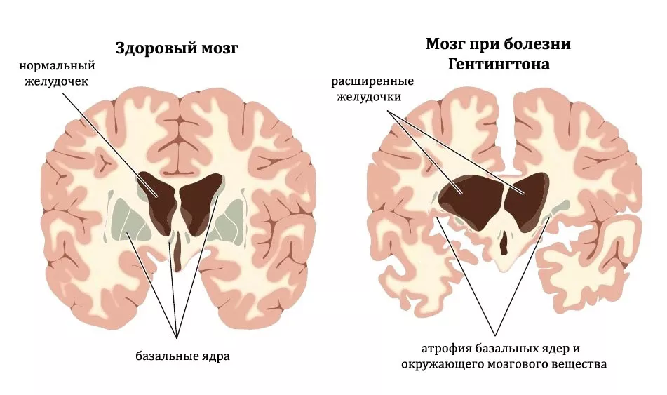 normal and HD brain.jpg