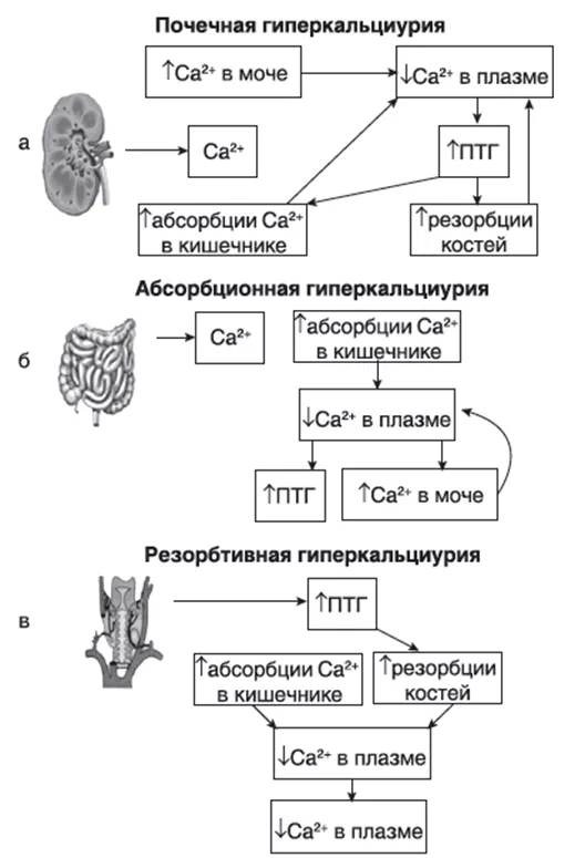 Основные факторы образования кальциевых мочевых камней