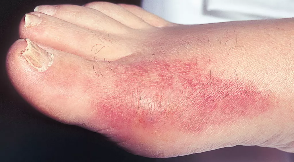 classical gout.png
