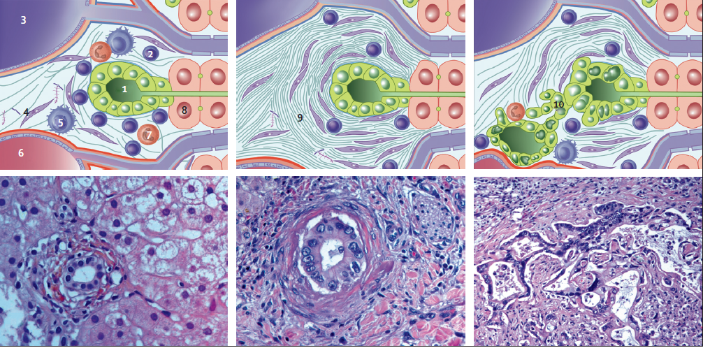 Патологические изменения желчевыводящих путей при первичном склерозирующем холангите (микроскопические изменения) Патологические изменения желчевыводящих путей при первичном склерозирующем холангите (микроскопические изменения)