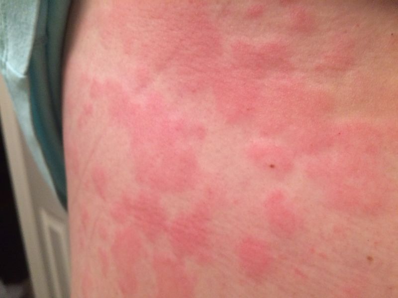 Mast cell activation syndrome.jpg
