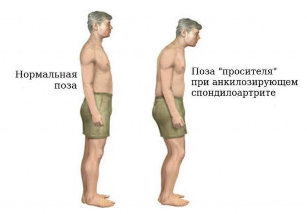 «Поза просителя» при болезни Бехтерева