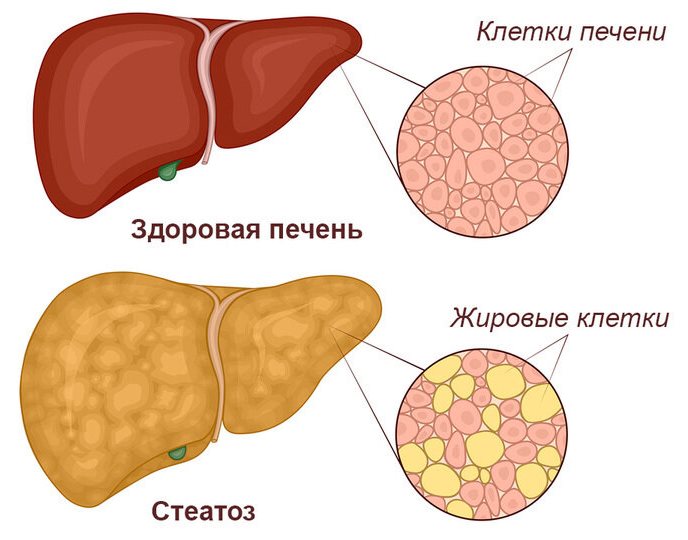 Неалкогольная жировая болезнь печени.