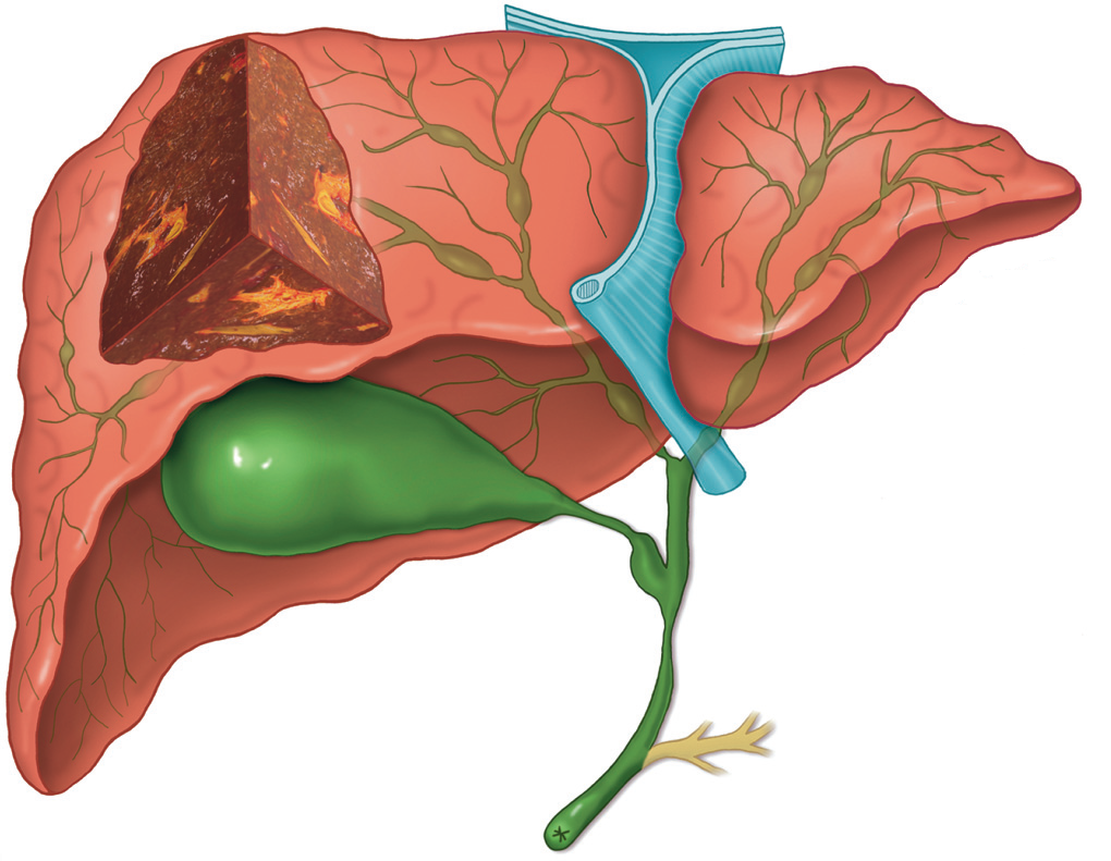 Патологические изменения желчевыводящих путей при первичном склерозирующем холангите (макроскопические изменения)