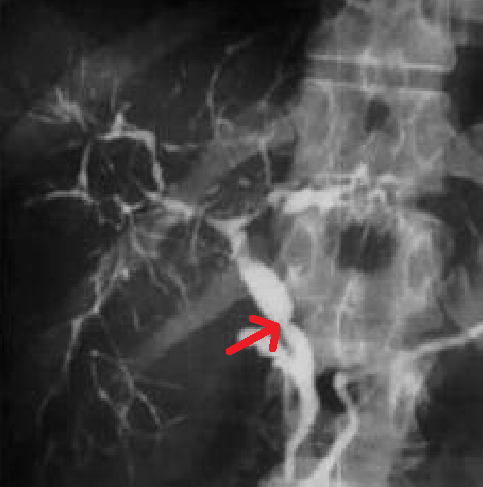 Стриктура холедоха (по данным МРХПГ)